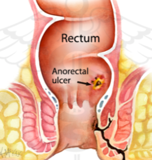 fistula in ano