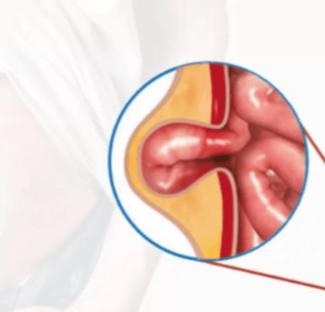 hernia